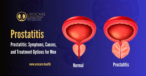 reddit prostatitis|prostatitis caused by stress.